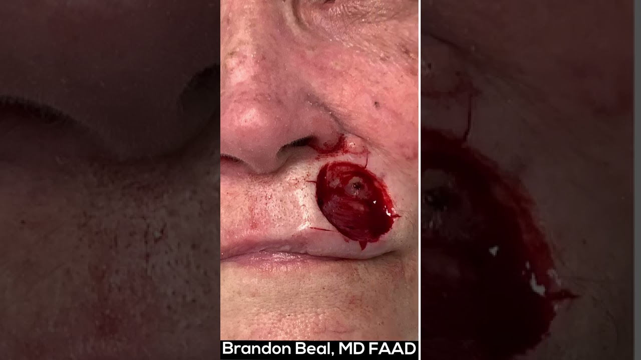 Mohs Lip Repair | St. Louis Dermatology & Cosmetic Surgery