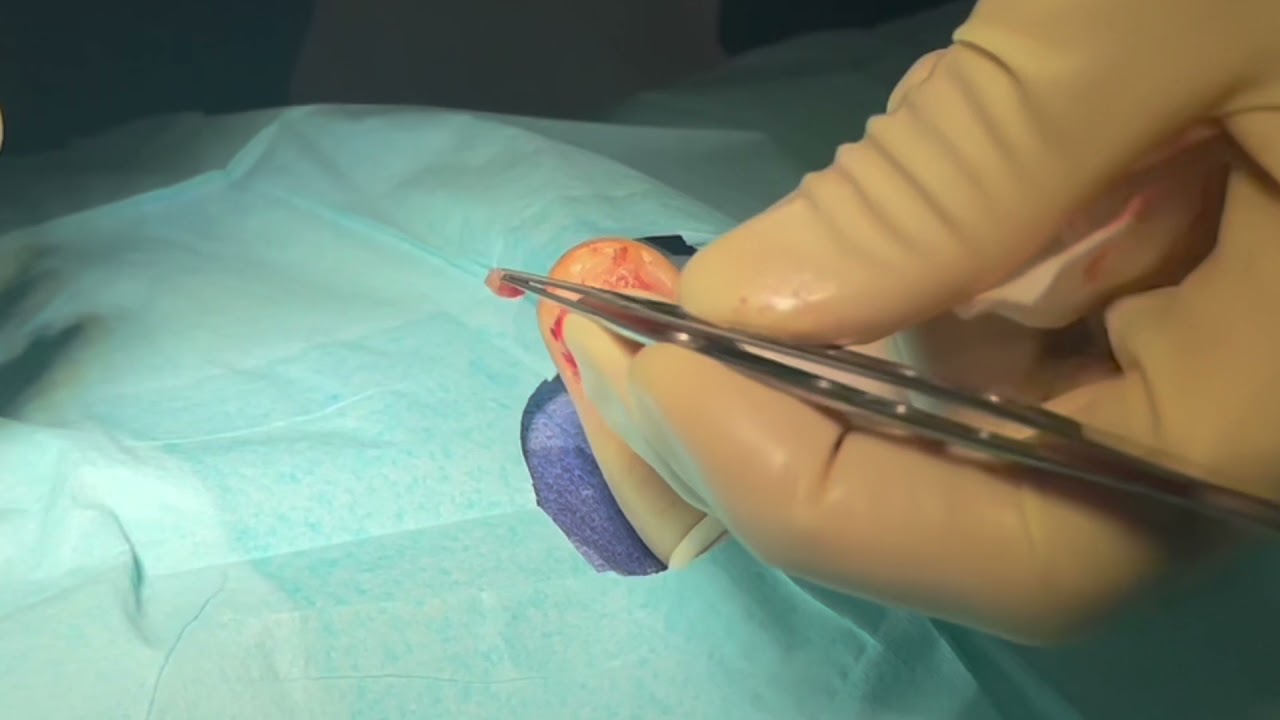 Glomus Tumor Removal Jacksonville Dr. Beal