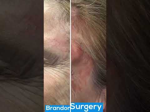 Mohs Surgery on a Patient's Face Before & After | St. Louis Dermatology & Cosmetic Surgery