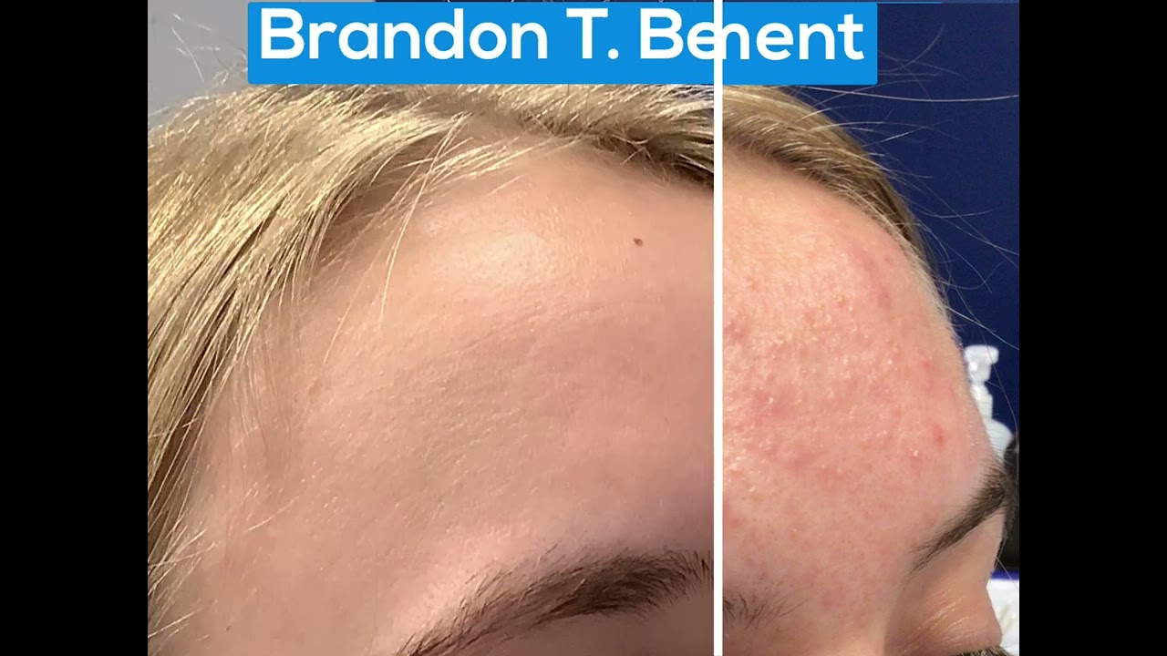 Forehead Acne Cure | St. Louis Acne Treatment