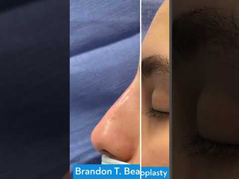 Non Surgical Rhinoplasty | St Louis Dermatology & Cosmetic Surgery | Before and After