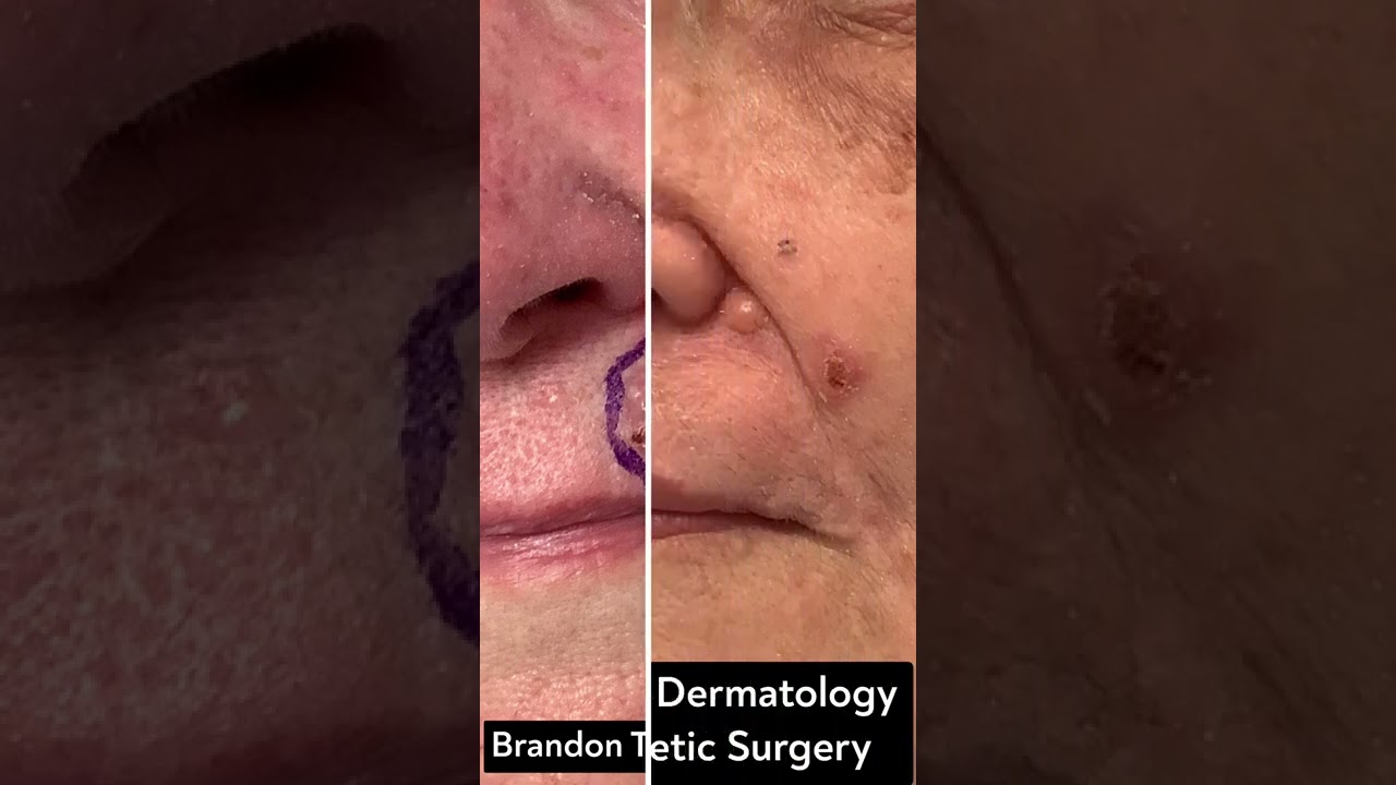 Basal Cell Carcinoma Tumor Before & After | St. Louis Dermatology & Cosmetic Surgery