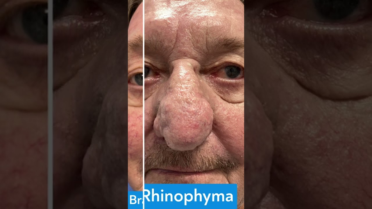 Rhinophyma Treatment Before and After | St. Louis Dermatology & Cosmetic Surgery