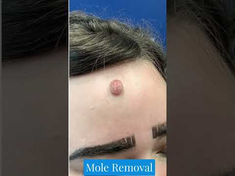 St. Louis Mole Removal | Mole Removal | Dr. Brandon T. Beal