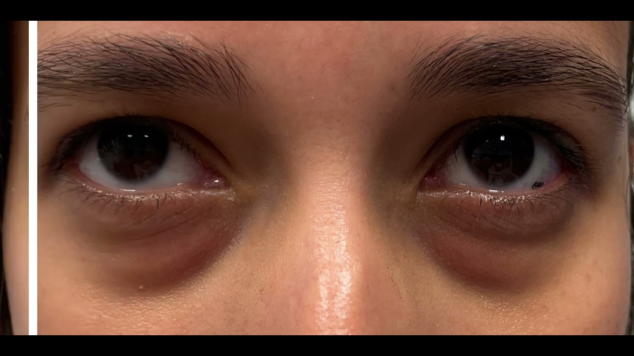 Treat Dark Under Eye Circles | Tear Trough Filler Before & After St. Louis