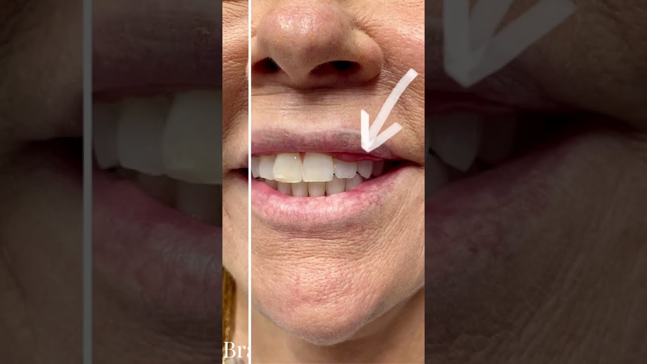 Lip Reduction Before and After to Unveil a Wider Smile - STL Dermatology & Cosmetic Surgery