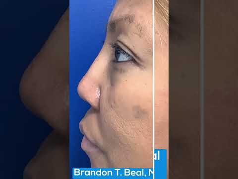 Non Surgical Nose Job | Dr. Beal | St. Louis Dermatology & Cosmetic Surgery