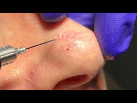 Telangiectasia Treatment on the Nose by Dr. Brandon Beal
