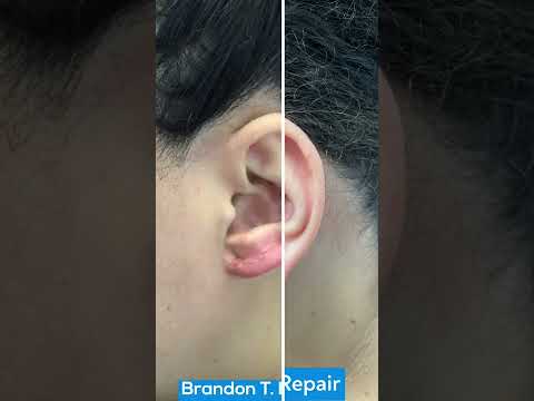 Earlobe Keloid Plastic Surgery Removal Before & After St. Louis