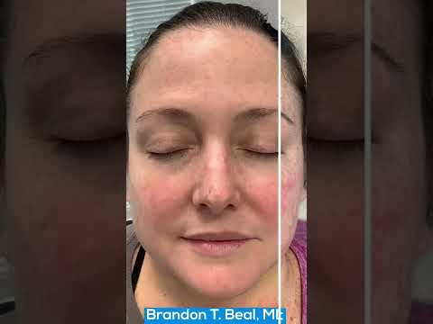 Blue Light Treatment Before & After | Treating Age Spots | Painless Blue Light Treatment St. Louis