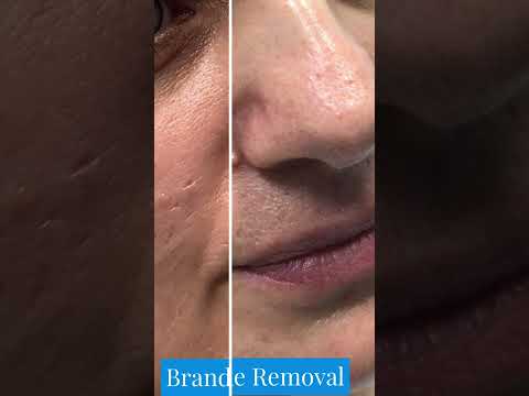 Scarless Mole Removal | St. Louis Mole Removal | STL Dermatology & Cosmetic Surgery