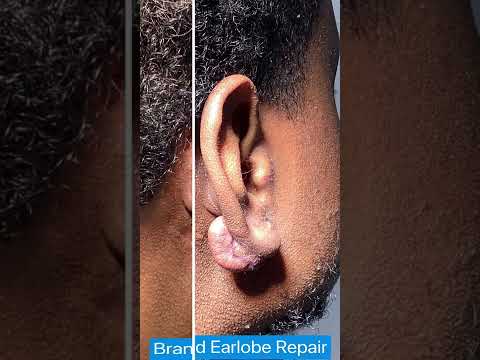 Ear Keloid Removal | Dr. Brandon Beal | St. Louis Dermatology & Cosmetic Surgery
