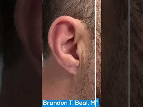 Large Gauged Earlobe Repair Before & After St. Louis | St. Louis Dermatology & Cosmetic Surgery