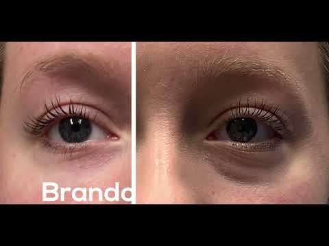 Tear Trough Filler St. Louis (Correct Dark Under Eye Circles) - Before & After with Amazing Results