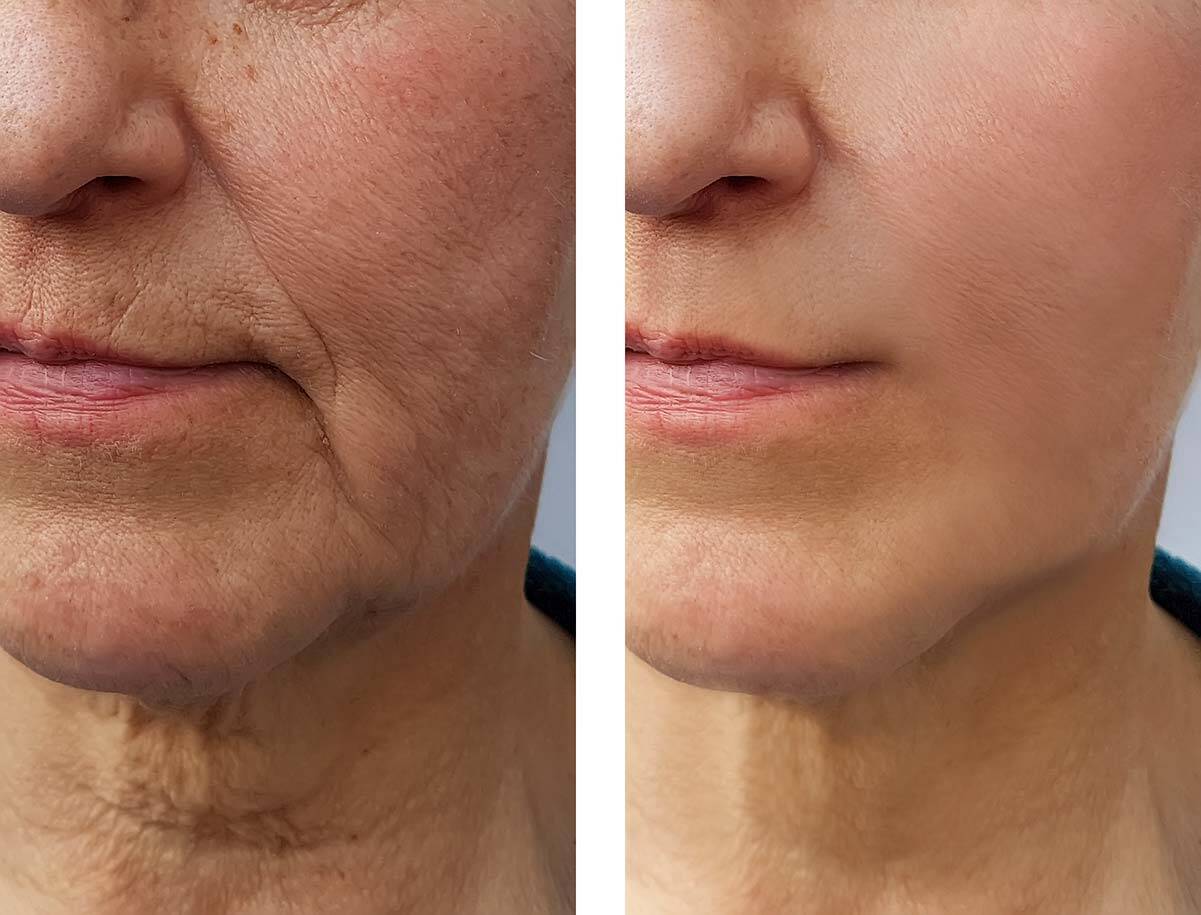 Microneedling Before And After 2 