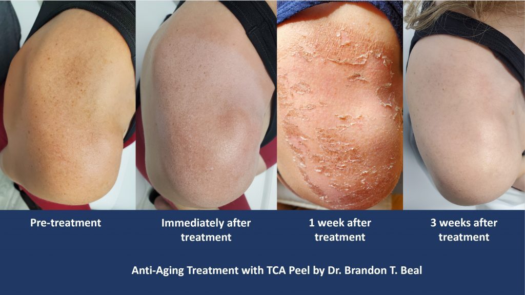 Chemical peels from a dermatologist