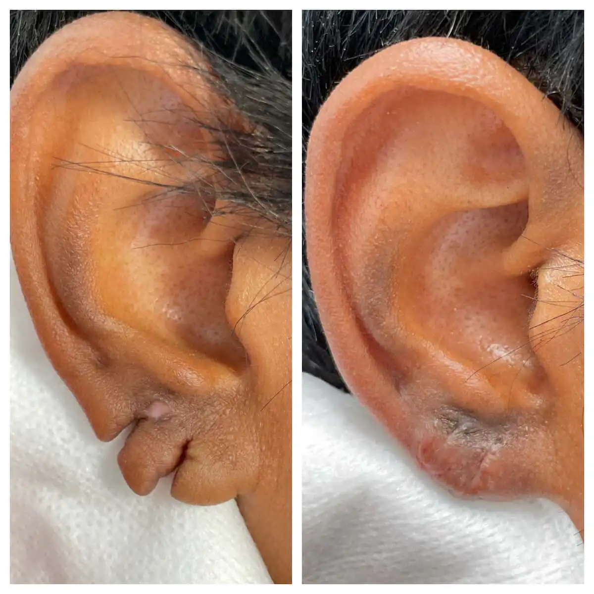 Earlobe repair before and after — St. Louis Dermatology & Cosmetic Surgery