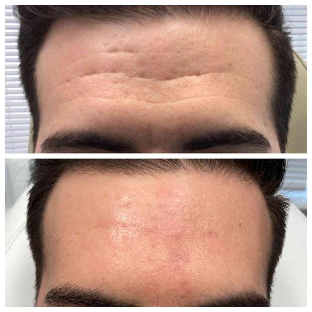 forehead-wrinkles-before-and-after