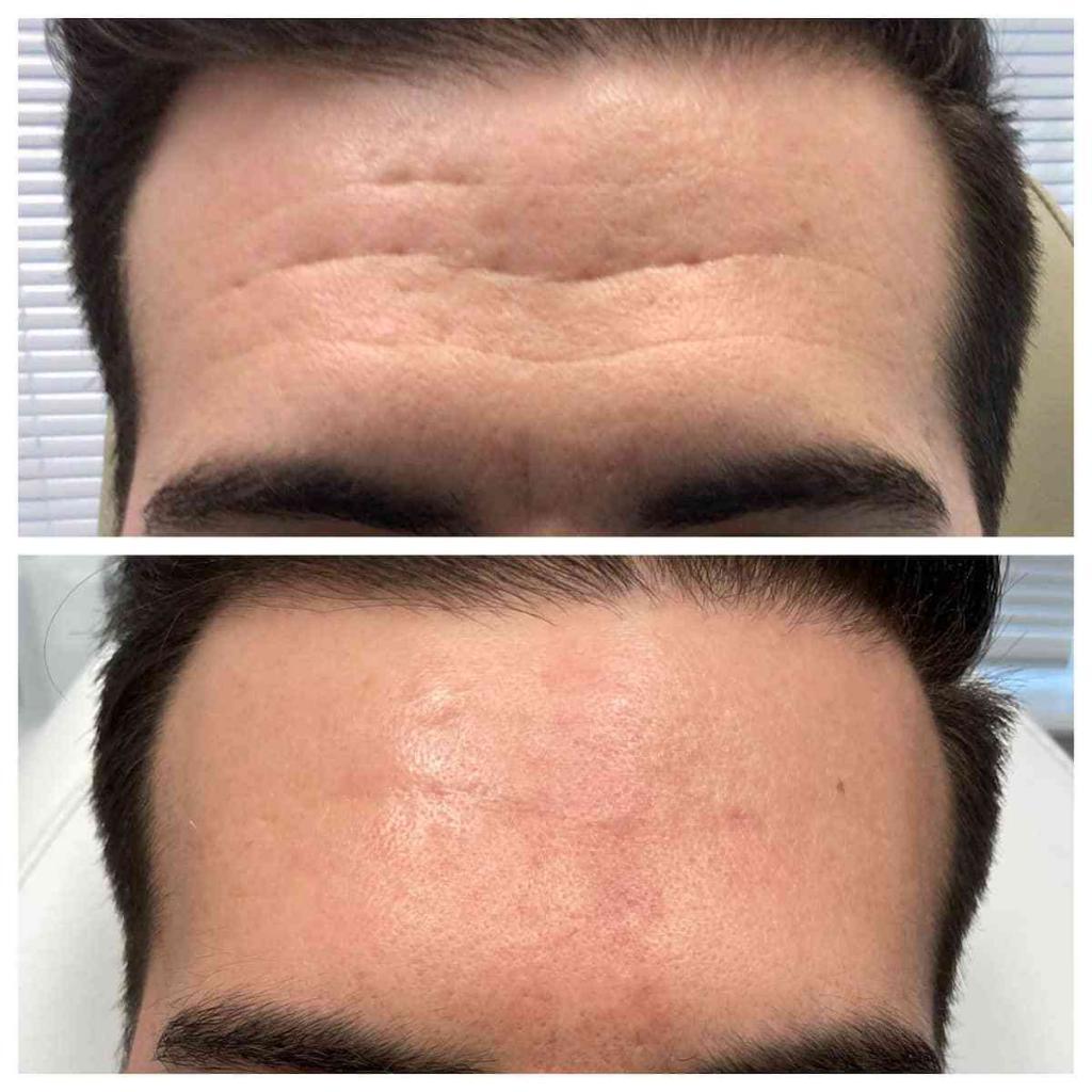Forehead Wrinkles How To Get Rid Of Forehead Wrinkles Forehead Wrinkles How To Get Rid Of Forehead Wrinkles