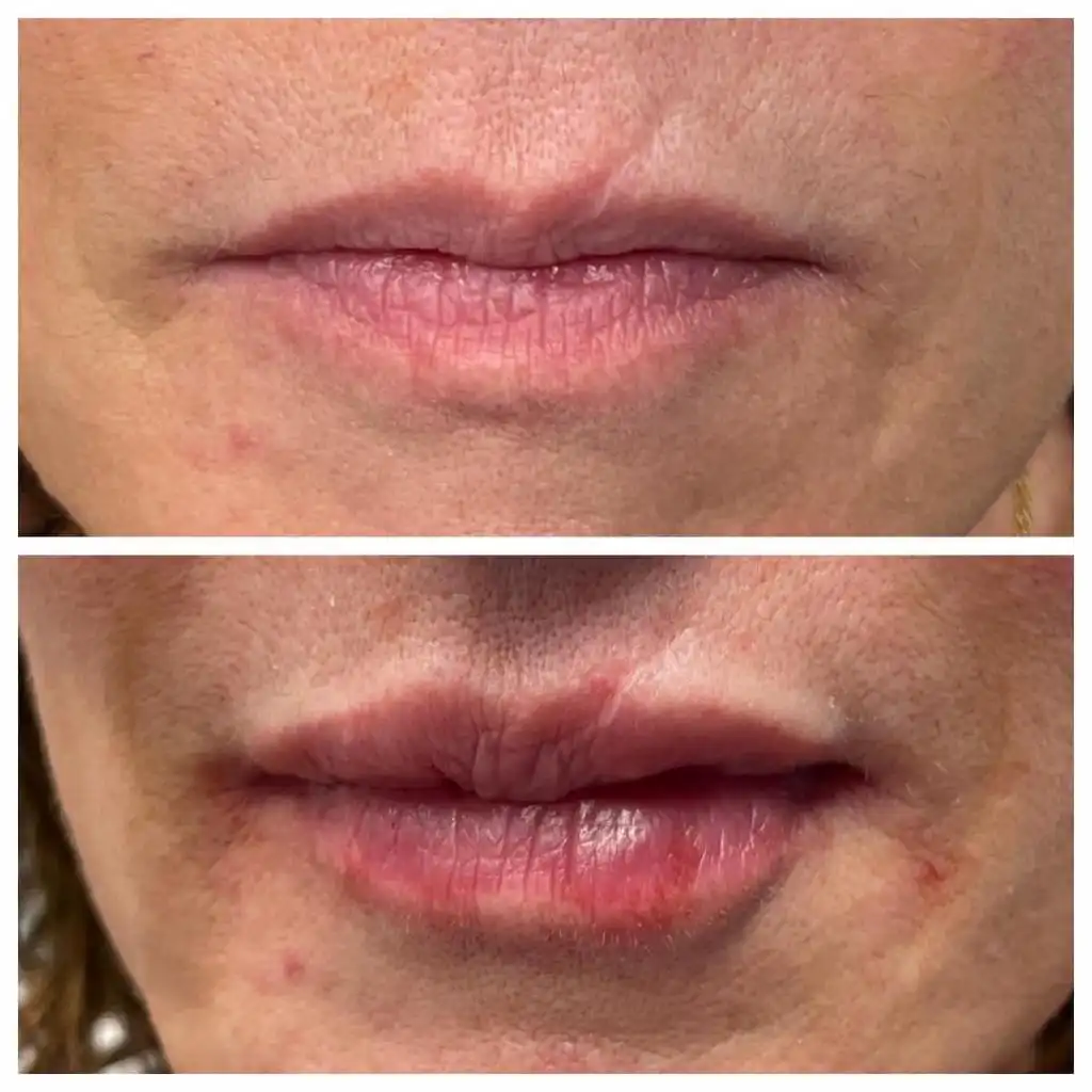 lip-filler (1)