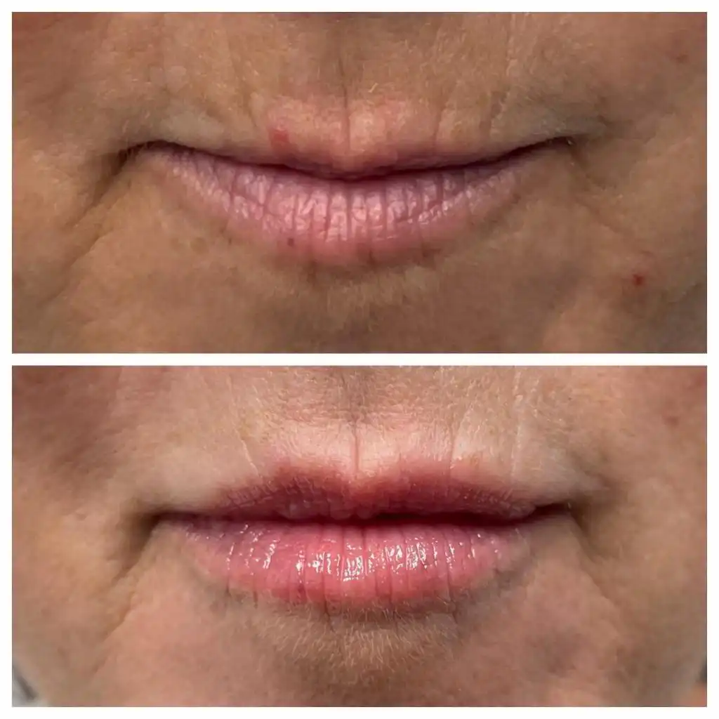 lip-filler (2)