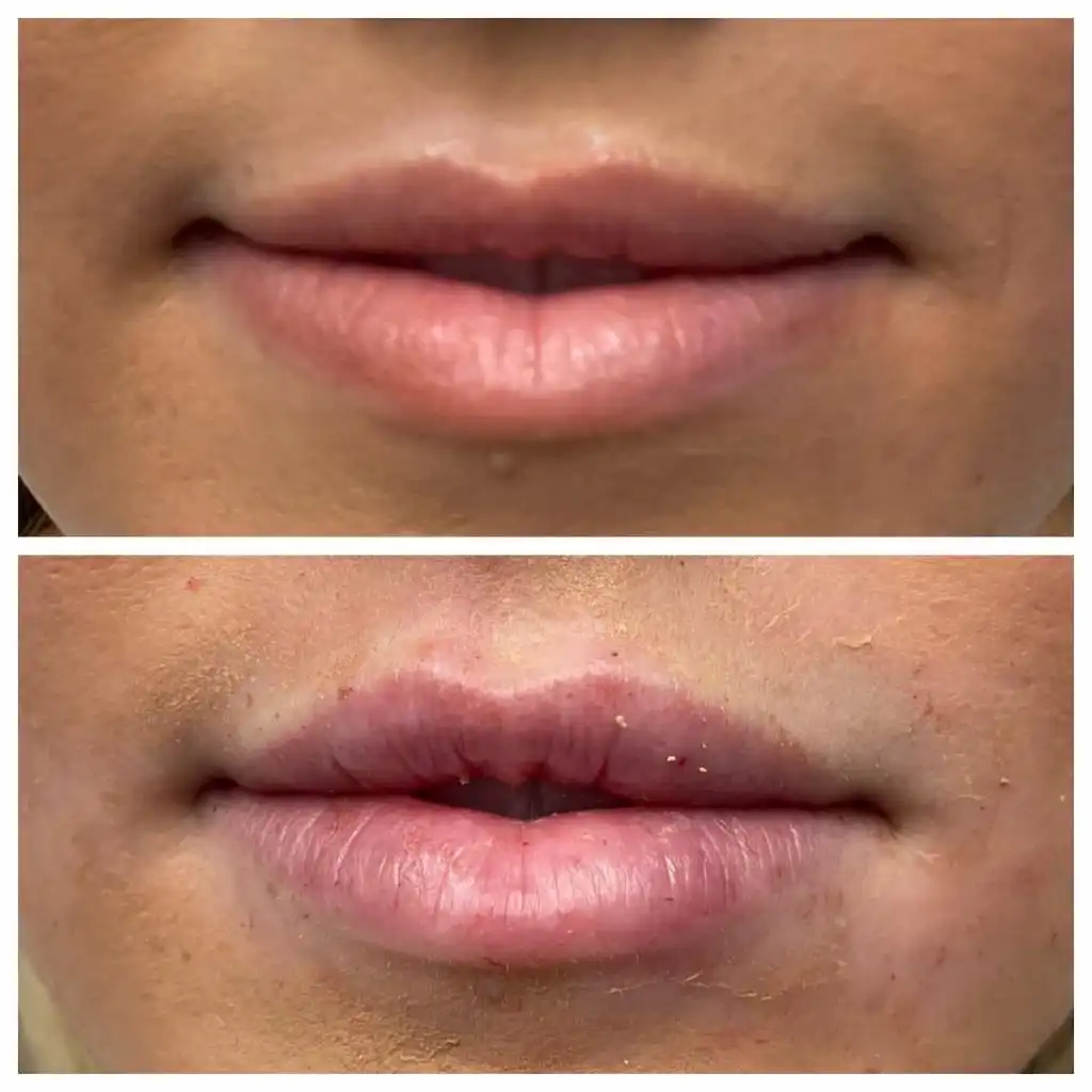 lip-filler (3)