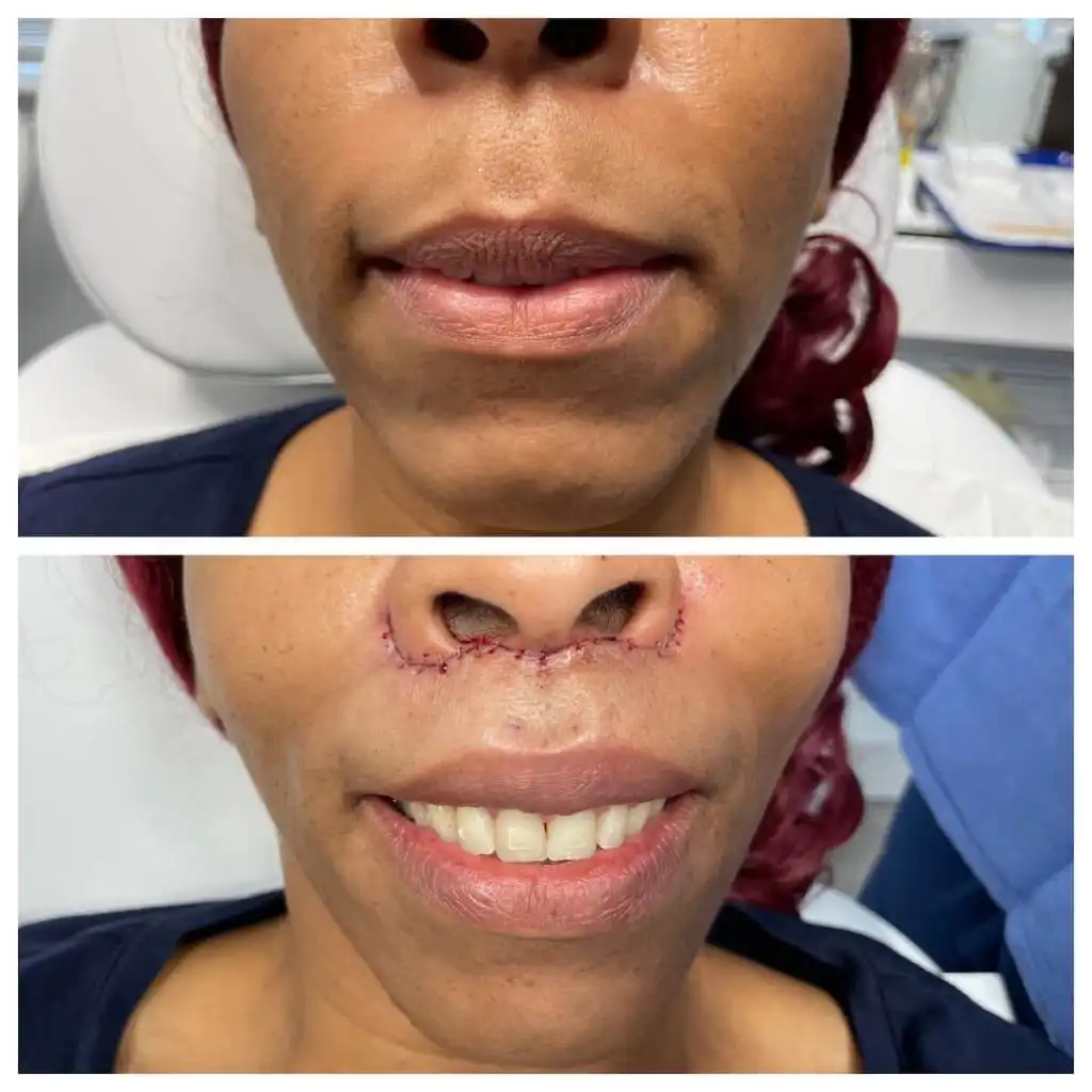 lip-lift (2)