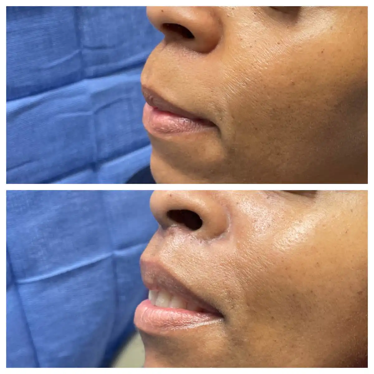 Lip lift before and after, oblique view — St. Louis Dermatology & Cosmetic Surgery
