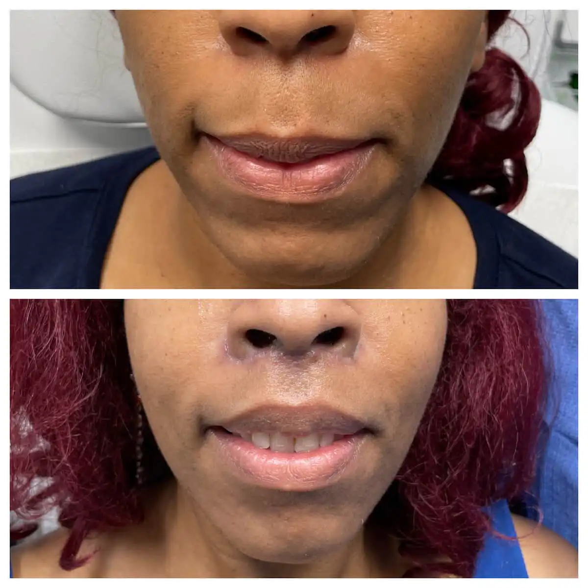 Lip lift before and after, front view — St. Louis Dermatology & Cosmetic Surgery