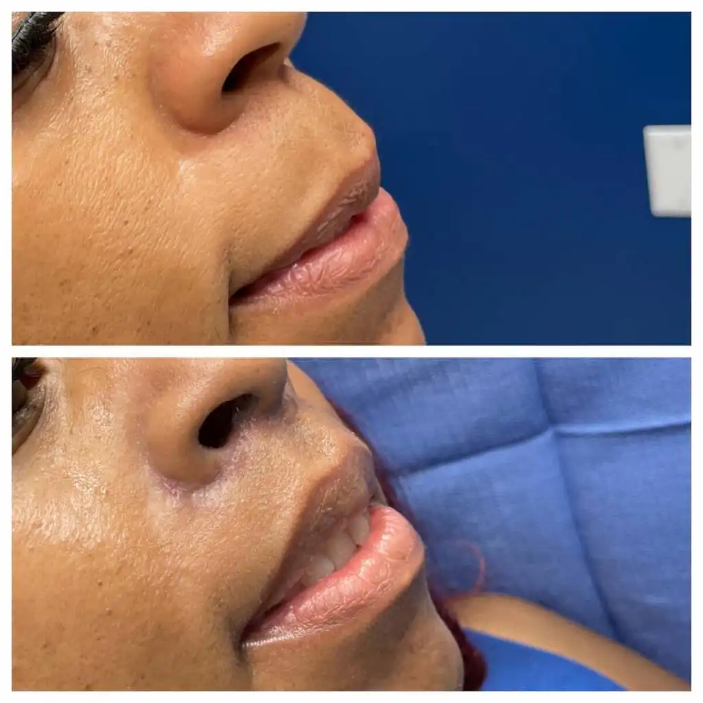 lip-lift (5)lip-lift (5)