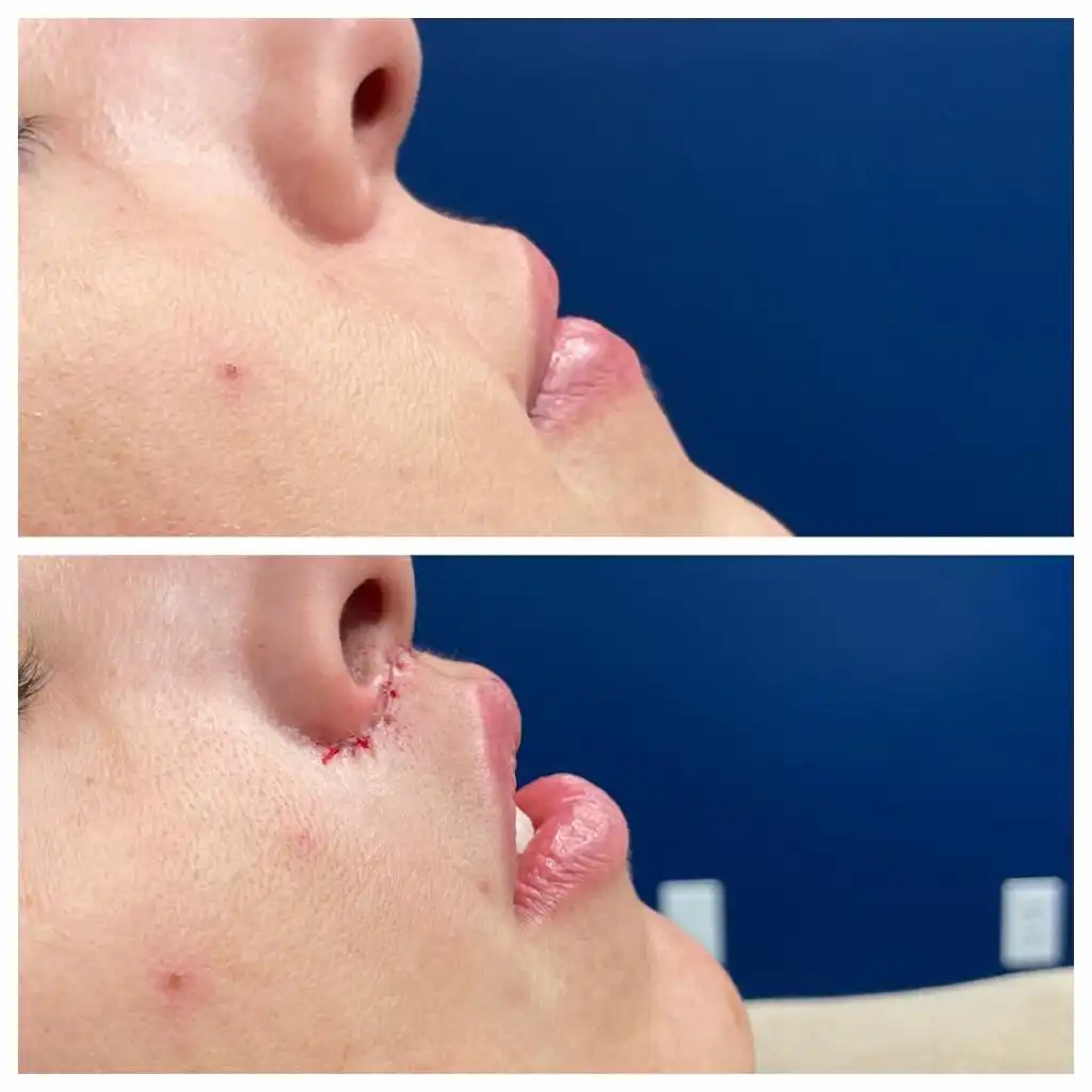 lip-lift (6)