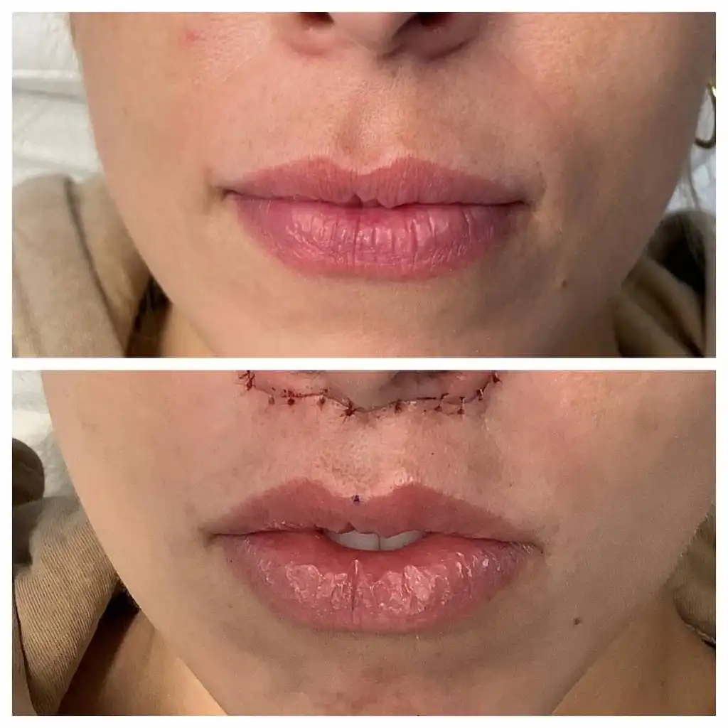 lip-lift (7)