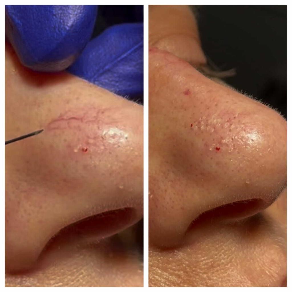 vein treatment nose