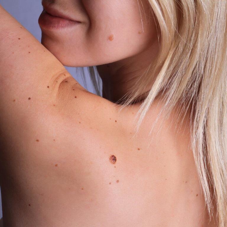 Skin cancer screening, examining moles, St. Louis Dermatology & Cosmetic Surgery
