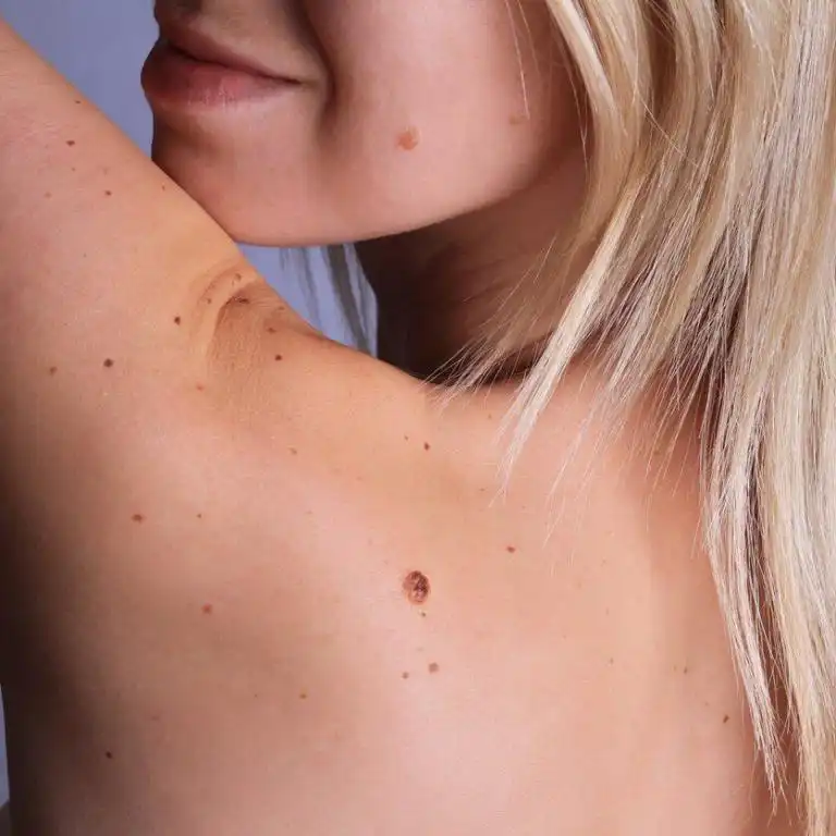 Skin cancer screening, examining moles, St. Louis Dermatology & Cosmetic Surgery