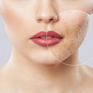 acne-scar-treatment