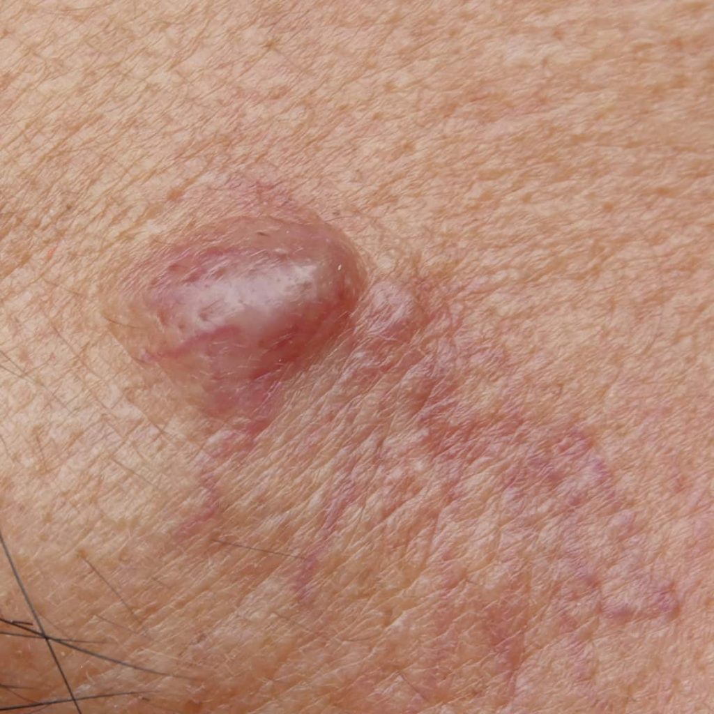 sebaceous cyst rupture