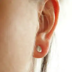 Earlobe Repair Surgery JAX