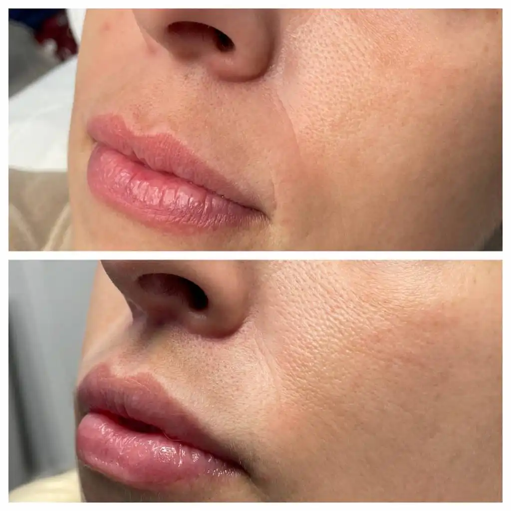 lip-lift