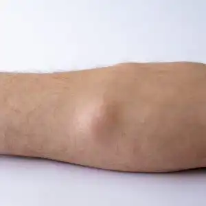lipoma-removal