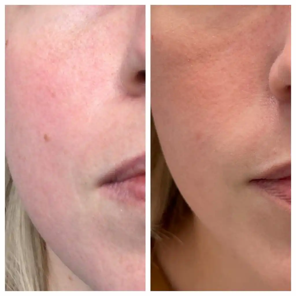 mole-removal-jacksonville-3