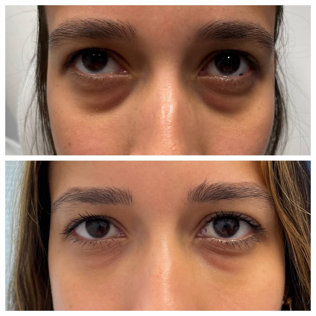 non-surgical eyelid lift