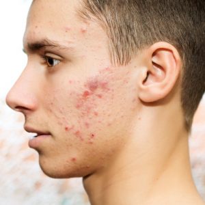 Teen Acne Treatments