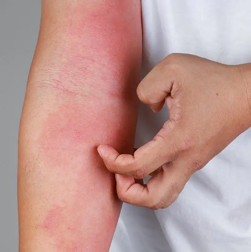 Treatment for Eczema JAX