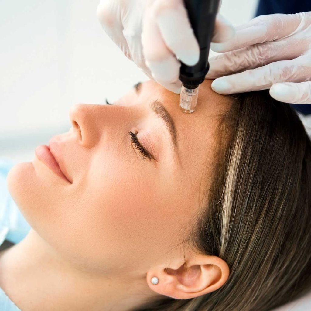 Benefits of Microneedling