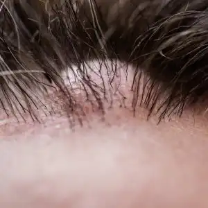 Cyst Removal Dermatologist JAX