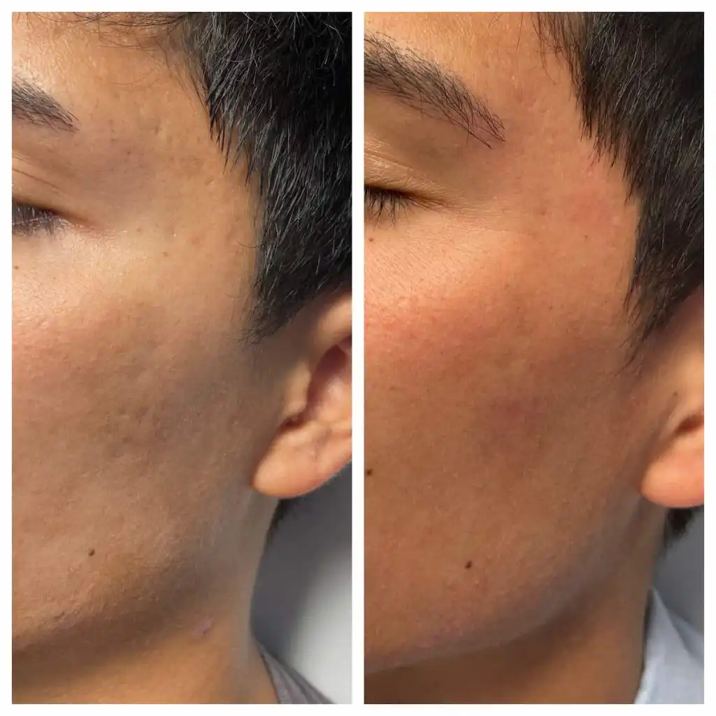Acne scar treatment with subcision and TCA CROSS before and after — St. Louis Dermatology & Cosmetic Surgery