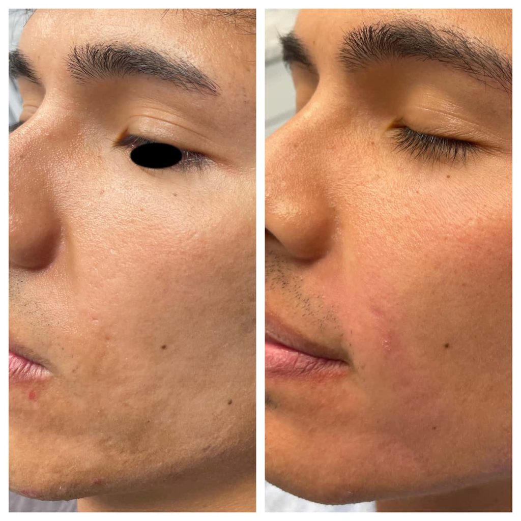 acne-scar-treatment (2)