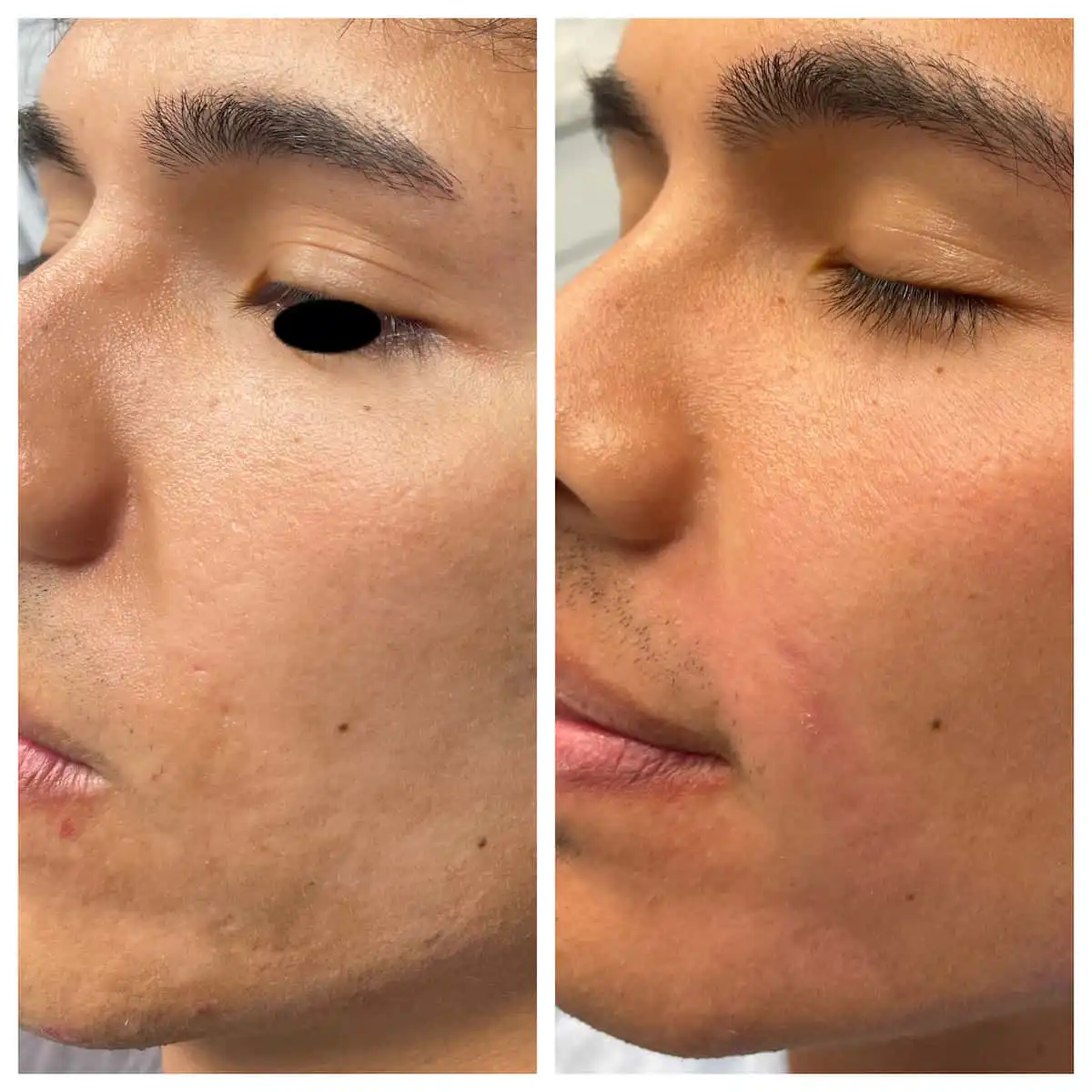 Acne scar treatment with subcision and TCA CROSS before and after, additional view — St. Louis Dermatology & Cosmetic Surgery