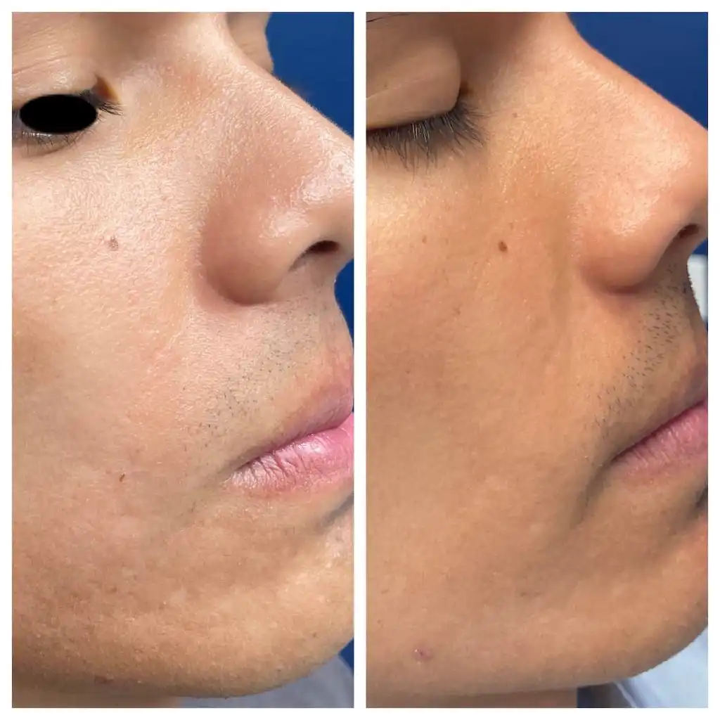 Acne scar treatment before and after, profile view, patient of Dr. Brandon T. Beal